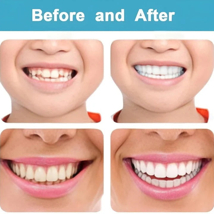 2Pcs/Set Comfort Fit White Teeth Cover Veneer Kit